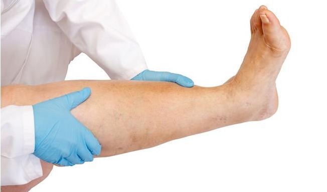 肥胖者|什么人容易招惹血栓？不瞒你说，3类人真的防备点，别给血管添乱