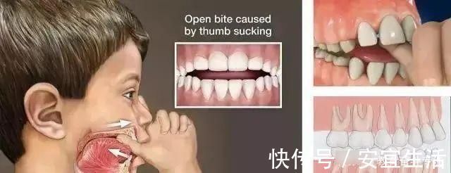 畸形|父母請注意:孩子12歲之前必須矯正的幾種牙齒畸形