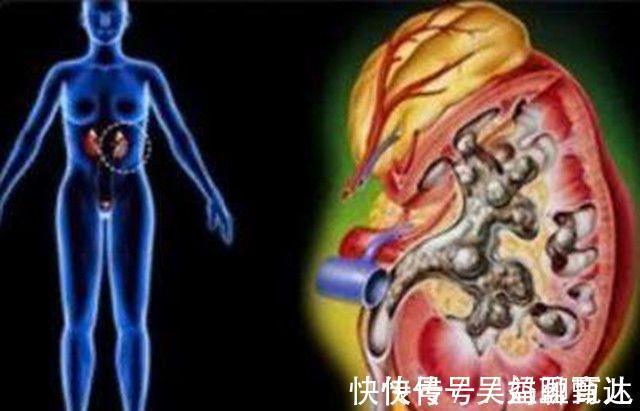 碎石|得了肾结石不要慌，4种食物经常吃点，赶跑碎石、排石一步到位