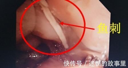 溶解|吃鱼被”鱼刺“卡，一定不要在”喝醋“了，唯有此样取鱼刺才安全