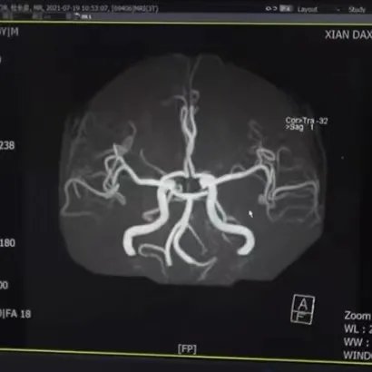 诱发|20岁女生长期熬夜诱发癫痫？不仅仅是癫痫，熬夜的危害是多方面的