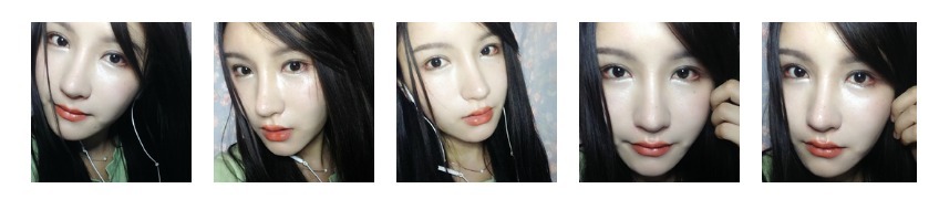 开眼角前后对比照效果图67天记录日记-焦作完美俪人案例