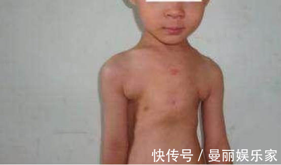 鸡胸|为什么患上“鸡胸”的宝宝越来越多做父母的责任很大啊