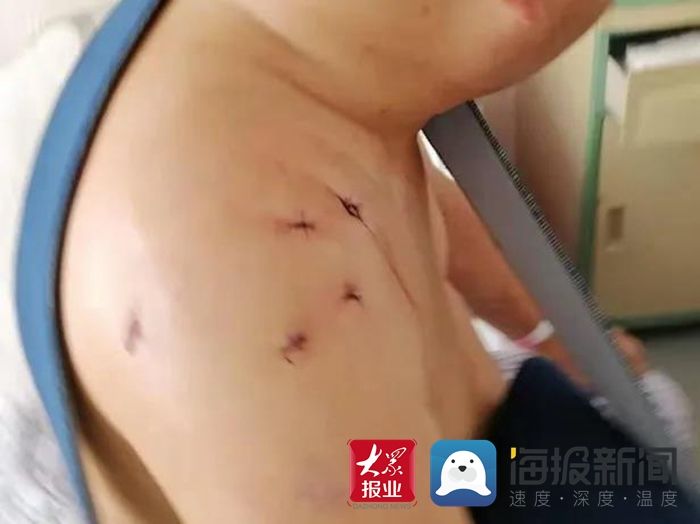 肩周炎|祝贺！“Chinese Way”技术在菏泽市牡丹人民医院“落地开花”