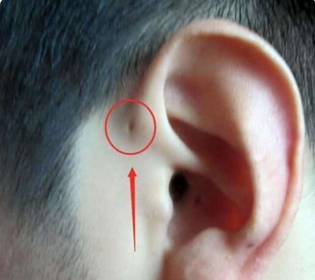 文文|为什么有些孩子耳朵会有“小孔”医生一般不说，父母心里要有数