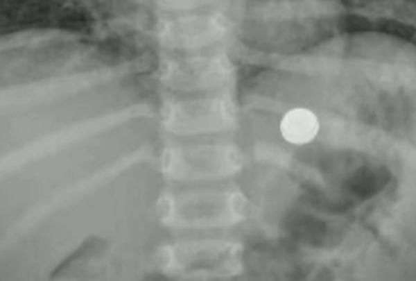 家长|男童好奇误吞纽扣电池后送医，家长觉得没大碍直接抱回家