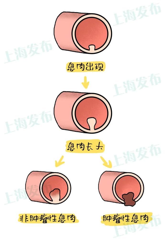 麻醉|【医聊】肠息肉是怎么长出来的?要不要割?