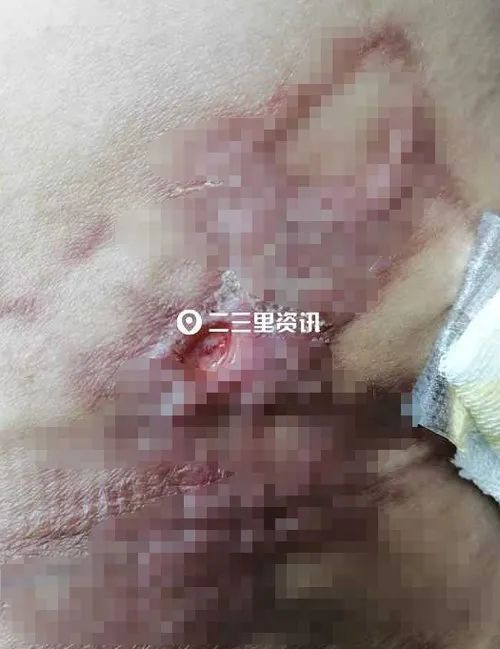 第一医院|女子抽脂手术后出现瘢痕维权难，瑞鑫医美：对方体质原因导致