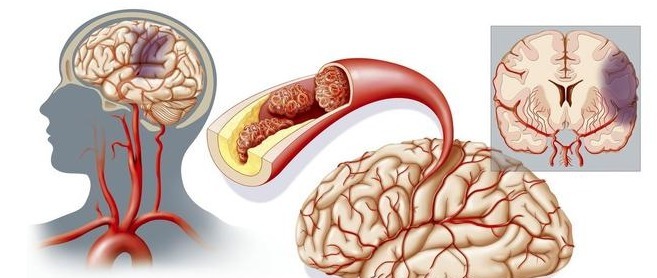 糖尿病肾病|高血压患者自查,5种降压药,你选对了吗选错会造成严重后果!