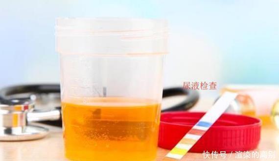 想要躲开高尿酸，几种天然“排酸王”常吃，别再花冤枉钱