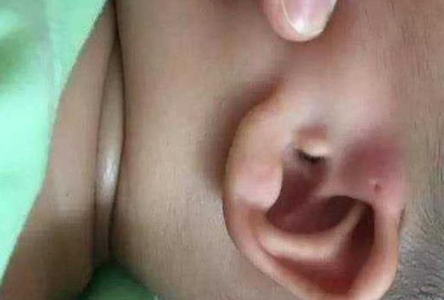 家长|为什么有的新生儿耳朵有“小孔”?医生一般不说,家长心中要有数