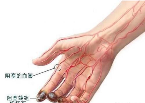 血管堵塞,血液粘稠的人,晚上睡觉时,身体会发出哪些信号?
