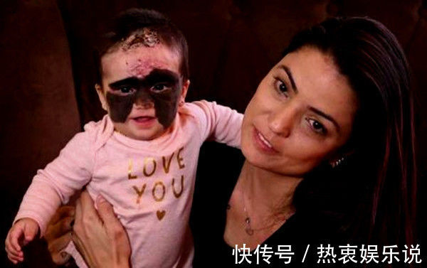 胎记|为消除胎记做7次手术,曾红遍网络的“蝙蝠侠”女孩,如今成这样