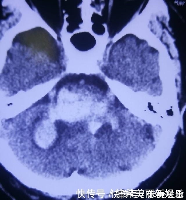 抢救|为省钱脑出血，ICU抢救积蓄花光医生痛心高血压8个误区害人啊