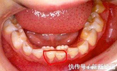 家长们|送给孩子正在换牙的父母们，你们一直都做错了什么？