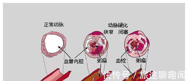 他汀类药物|出现胸痛,如何判断是不是冠心病引起?本文教您如何快速识别