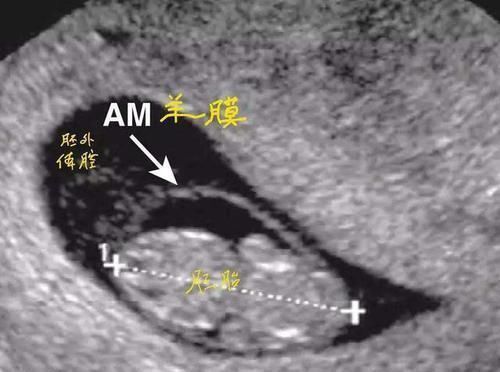 宝妈|孩子出生自带“金钟罩”,护士连连道喜,产妇:我生了个哪吒?