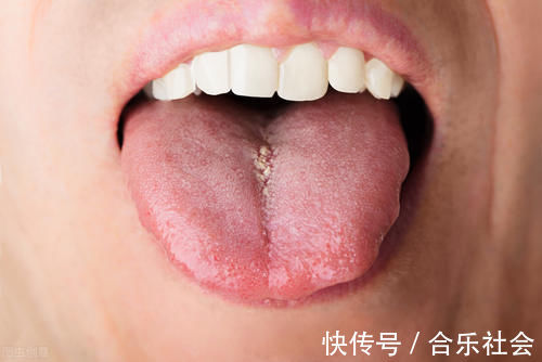 发黄|看舌相判健康，裂痕舌，齿痕舌，发黄舌，紫黑舌？中医一次说清楚