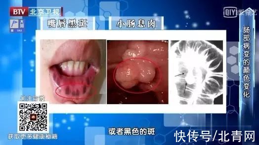 甲亢|各种疾病的早期信号,都在这里了!知道了省钱又救命,赶紧学起来