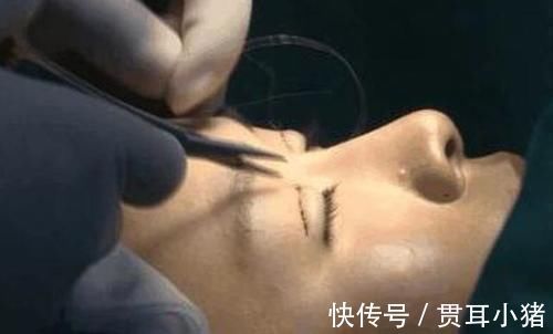 主刀医生|女子花60000整容,术后却整成“凹陷鼻”,找其理论主刀医生闭门不见
