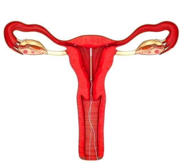 或许|生完孩子后，女性要“上环”吗？看完之后或许你就清楚了！