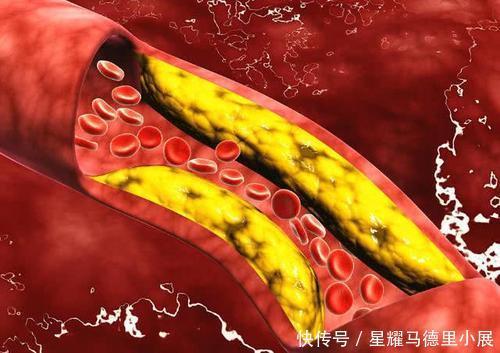 清道夫|血栓“清道夫”找到了!芹菜排第三,排在第一很多人都不知道