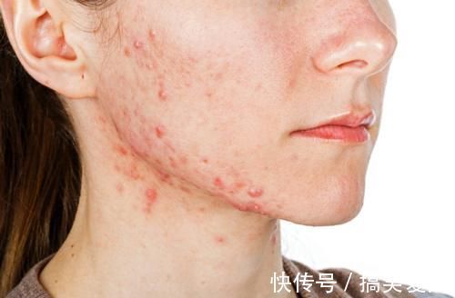 痘痘|有黑头、长痘痘怎么办?挤掉是下下策,这个方法不疼还省钱