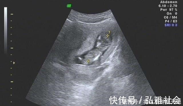 测量|孕期B超单直接反应胎儿状况,这5处孕妈要学会看懂,医生不会详说