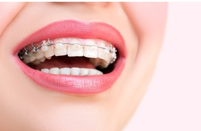 黄金期|孩子牙齿矫正,必须要12岁以后吗?你是否错过了孩子的矫正黄金期