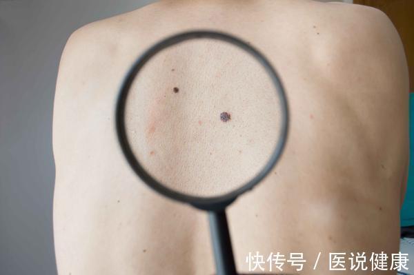 肝脏|身体出现4个“变化”,可能是脂肪肝的“敲门声”,别掉以轻心