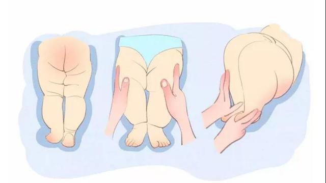 发育不良|宝宝髋关节发育不良戴吊带矫正会影响腿型吗