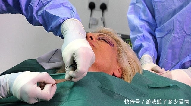 54岁女子贪图便宜，花费2万元在黑市整容，整容后年轻了20岁