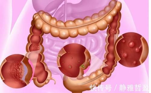 会长长|肠息肉会不会恶变为肠癌?关于肠息肉,这些问题你知道吗?
