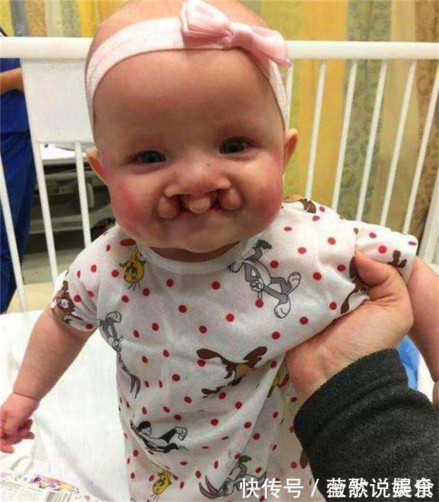 宝宝|24岁宝妈生下“兔子宝宝”,丈夫劝她放弃,手术后妈妈掩面而泣