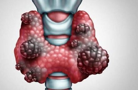 放射性物质|你那不疼不痒的甲状腺结节，其实危害更大！