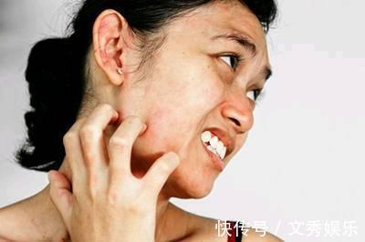 高血糖|血糖高不高，看脸就知道！若面部没4种表现，血糖还算稳定，恭喜