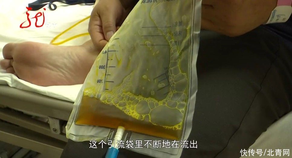 寄生虫|肚子里一天流出十多只虫子,就因为他吃了这种鱼……