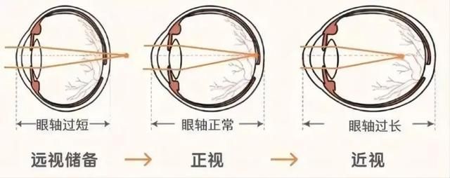 近视|每人天生有笔“存款”，限18岁前用！答案在眼睛里