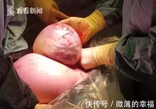 女子|女子剖腹产子,医生从肚子里取出一个肉球!网友:这是哪吒啊