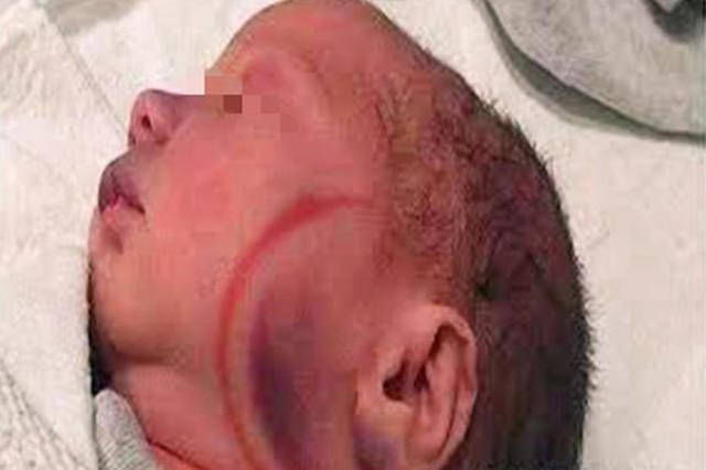 宝妈|1岁宝宝“产钳印”未消退,宝妈上医院讨说法,医生的话让她羞愧