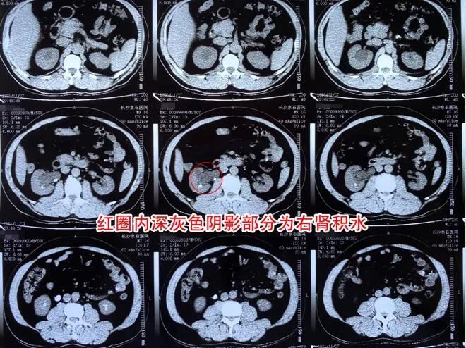 结石|男子偏爱喝浓茶，因此进了医院…