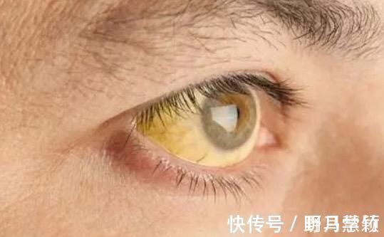 肝脏|肝病“最怕”1水,平时可劲喝,不出1个月,肝会“感激”你