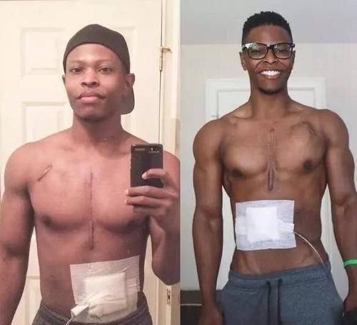 他没有心脏却仍坚持健身,美国27岁小伙感动全球