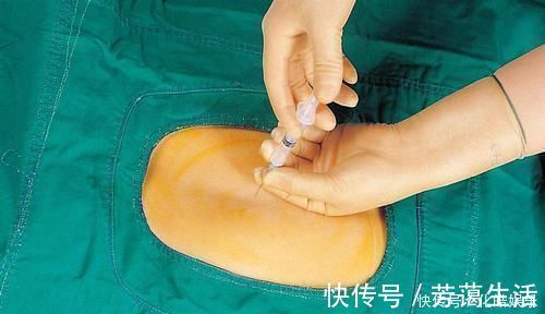 剖腹产|头胎剖腹产,二胎也可以顺产,但这3种产妇,头胎剖二胎就得剖