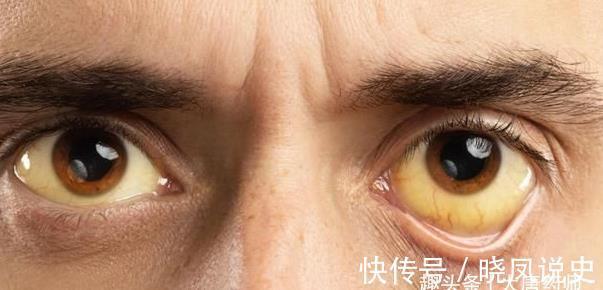 肝治|百病从肝治！灸5穴吃3宝，养肝、疏肝、护肝，肝“净”百病消！