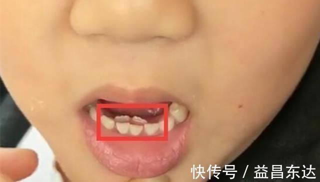 拔掉|6岁男孩长出“双排牙”,要一颗颗拔掉,妈妈自责不已,都怪我