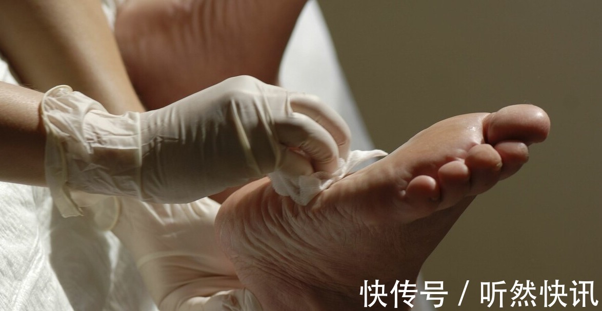 间歇性跛行|糖尿病足是每个糖友的“噩梦”!医生提醒出现4个症状就该警惕