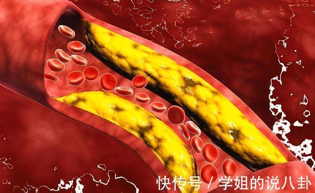 高血脂症|燕麦是高血脂的“发物”？医生：想降脂，3种“粗粮”建议多吃