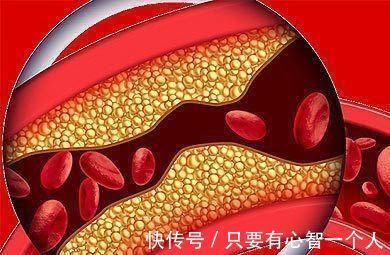 颈动脉斑块|查出颈动脉斑块先别慌,3项原则告诉你该如何处理,为健康了解下