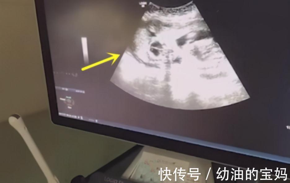 生育|10岁男孩哭求妈妈留二胎,逢产检比爸爸还积极,亲自看结果才放心